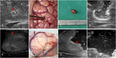 Intraoperative ultrasound in recurrent gliomas surgery: Impact on residual tumor volume and patient outcomes